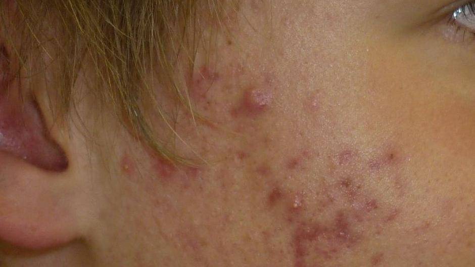 pickel im gesicht