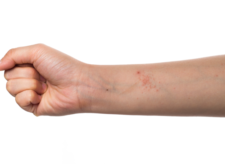 pickel am po loswerden