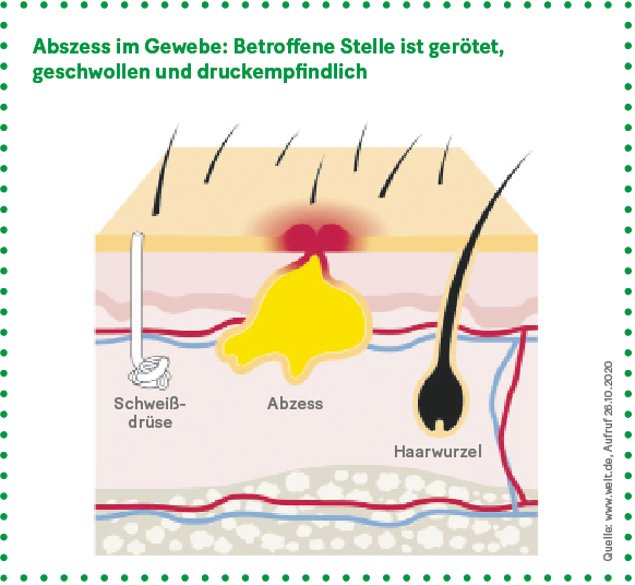 pickel entzündet geschwollen