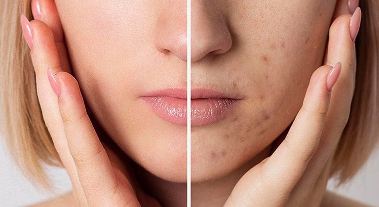 pickel über nacht weg hausmittel