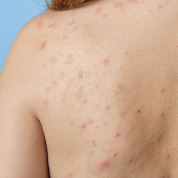 pickel am rücken loswerden