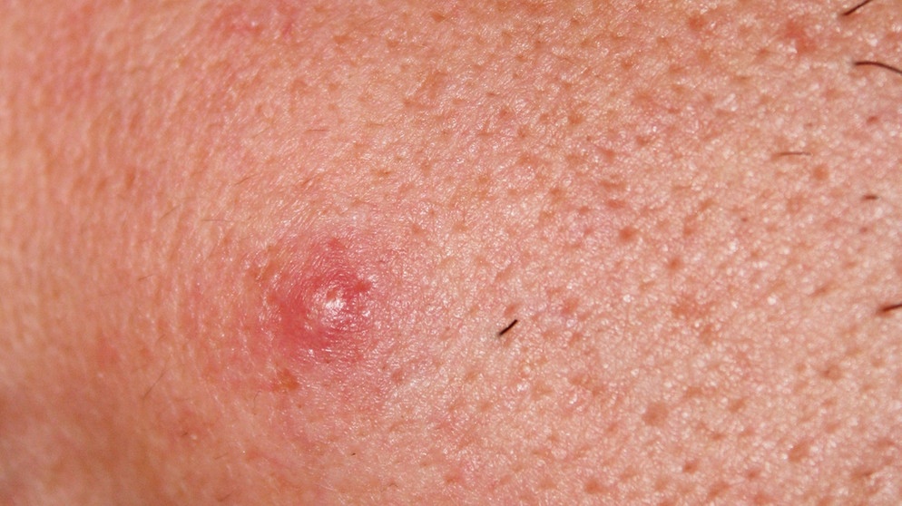 pickel und mitesser entfernen