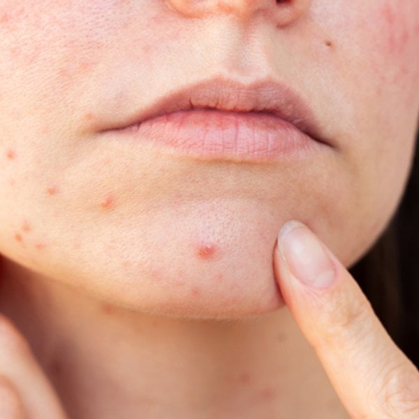 hormonelle pickel loswerden