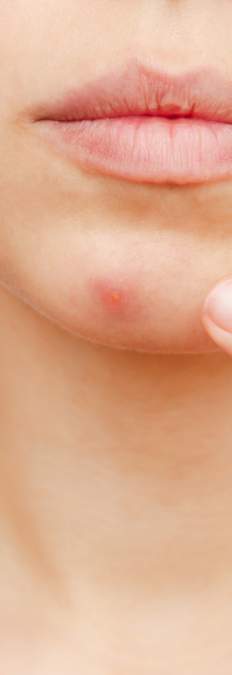 pickel am kinn loswerden