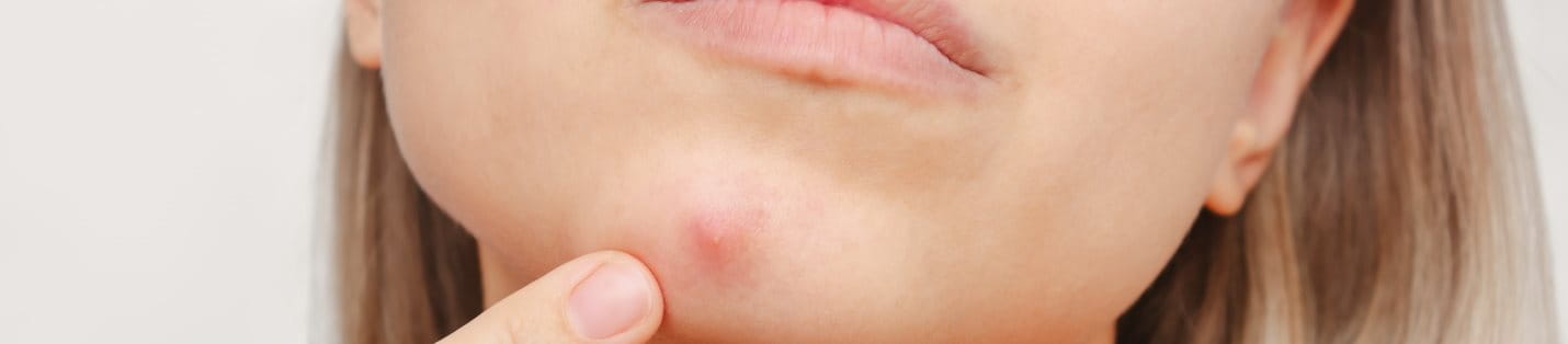 pickel am schnellsten loswerden