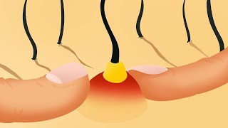 pickel auf der stirn loswerden