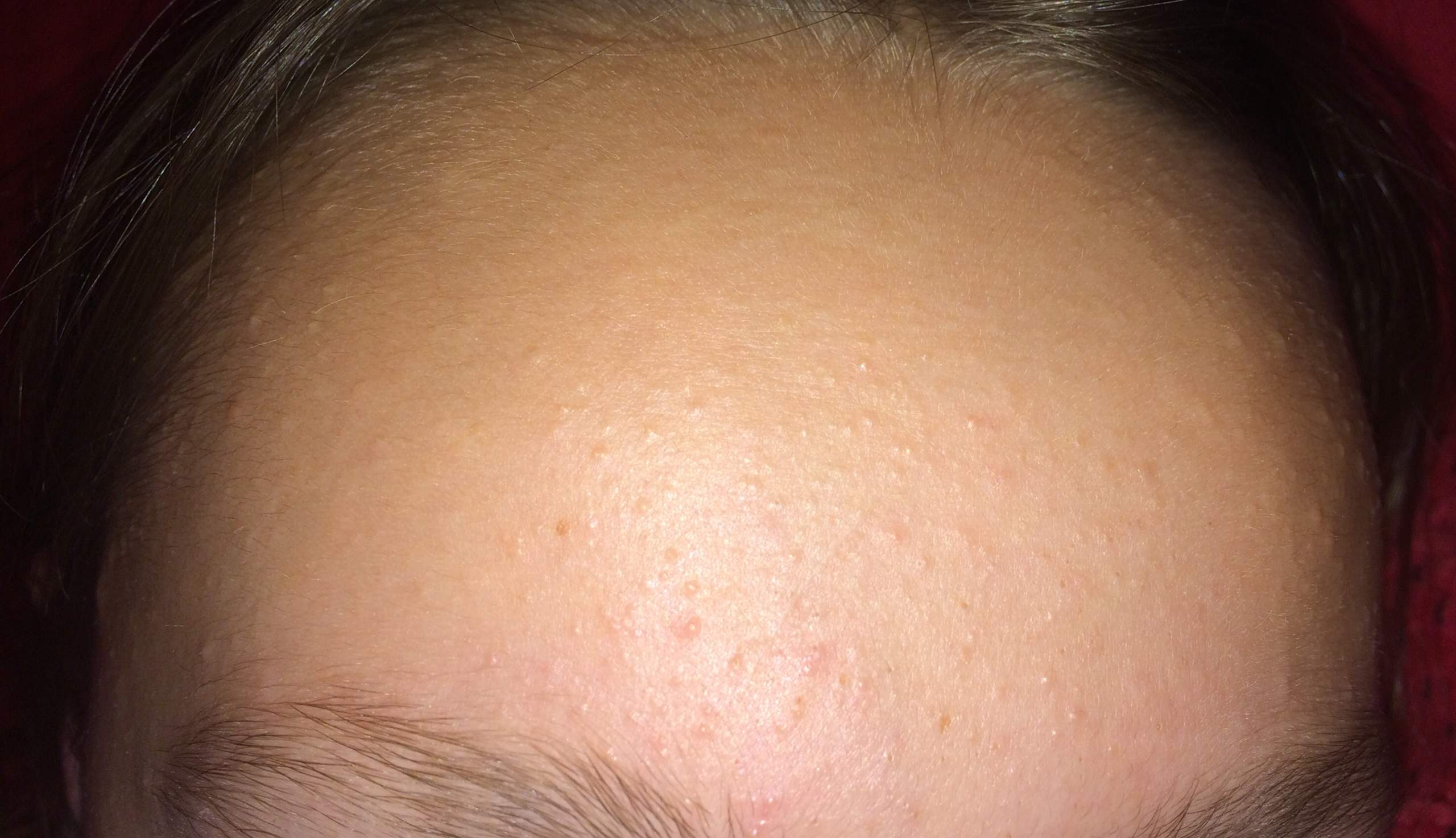 pickel auf stirn loswerden