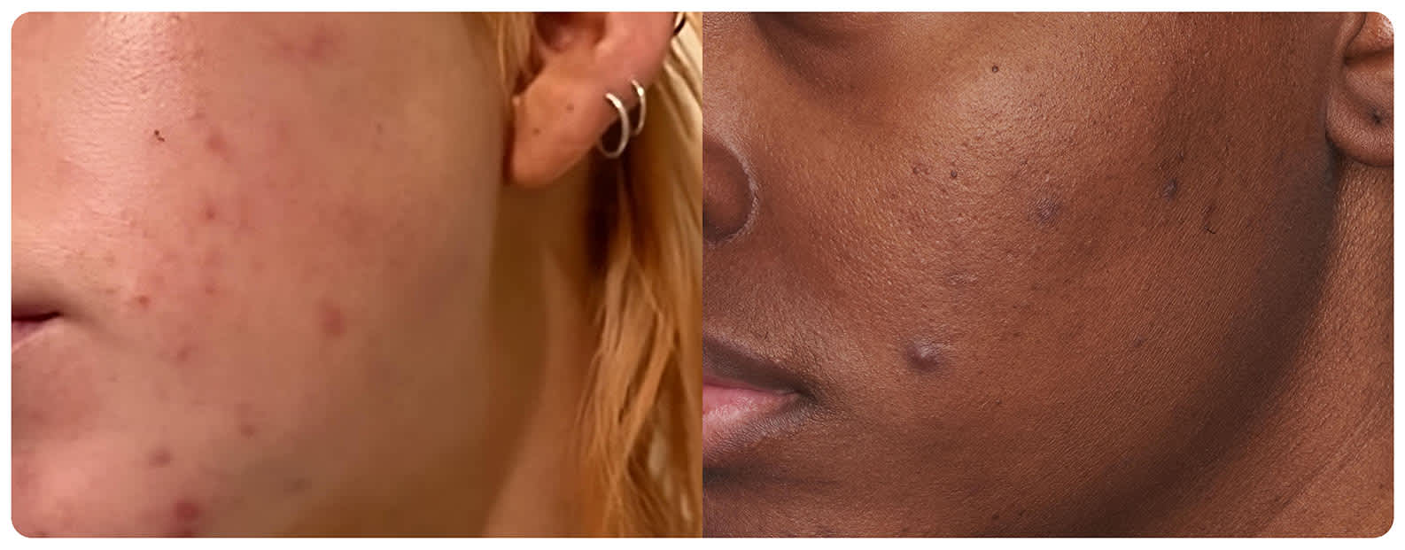 rote pickelmale entfernen