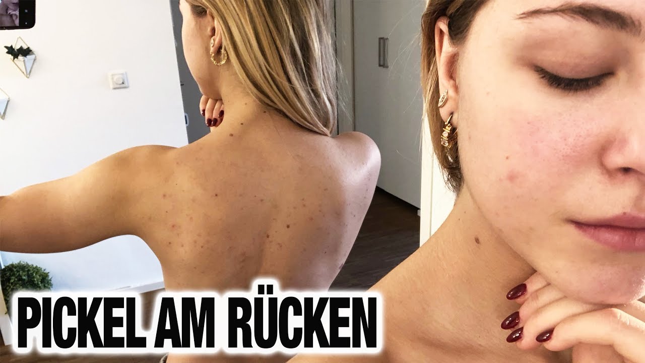 rückenpickel loswerden