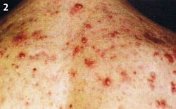 rücken akne loswerden