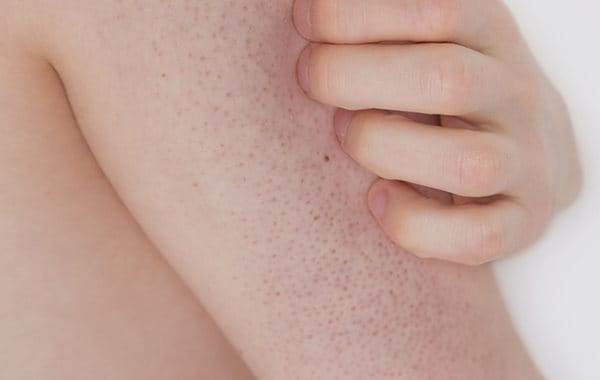 pickel am arm loswerden