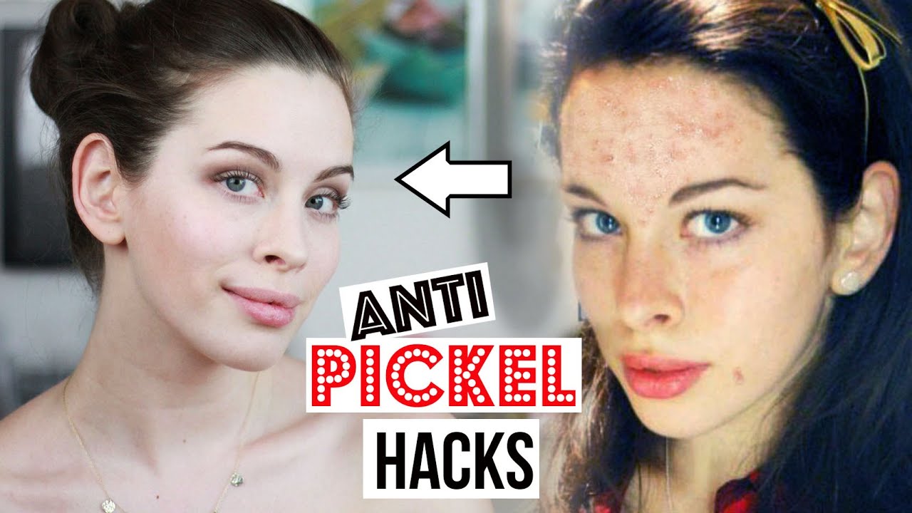 pickel auf der nase schnell loswerden