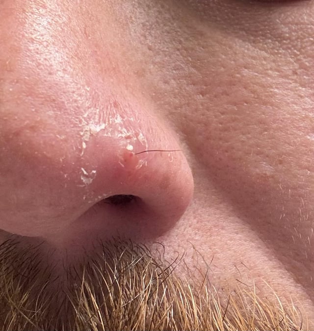 pickel auf der nase loswerden